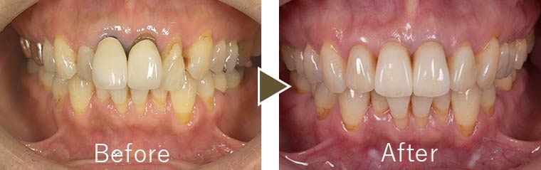 セラミック治療例1