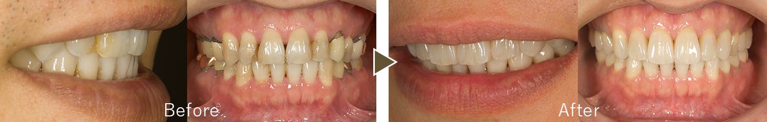 審美歯科治療例3
