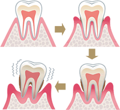 歯周病の治療
