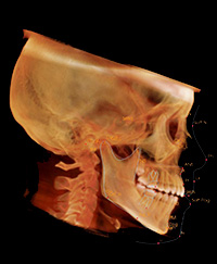 歯列矯正CTイメージ