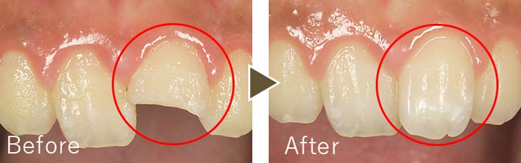 歯の破損治療例