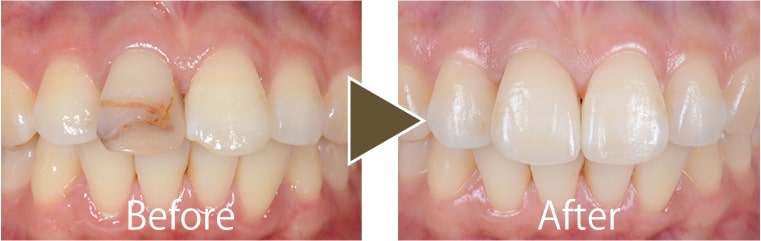 セラミッククラウン治療例2