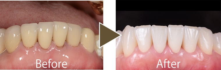 セラミッククラウン治療例3