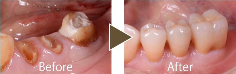 セラミッククラウン治療例4