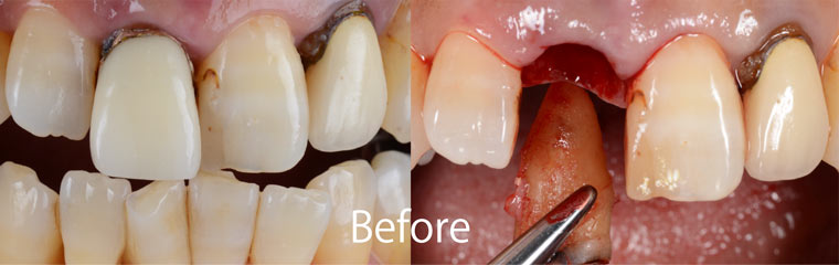 前歯部審美インプラント治療例1