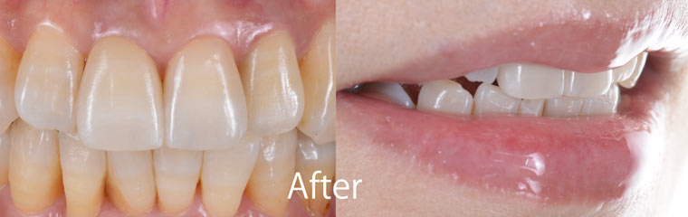 前歯部審美インプラント治療例2