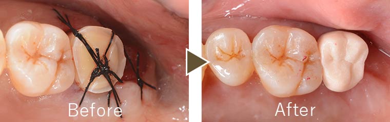 歯牙移植（歯の移植）治療例