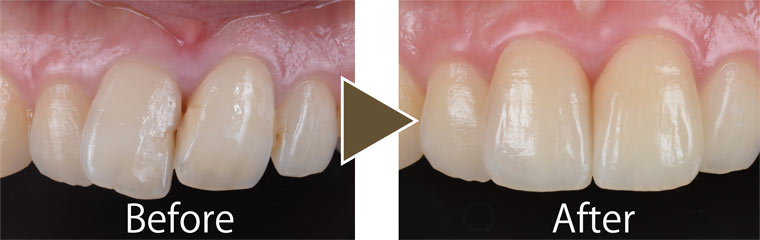 ラミネートベニア治療例1