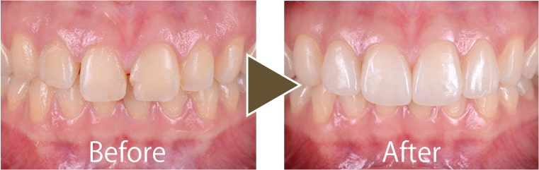 ラミネートベニア治療例2