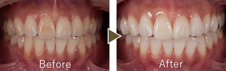 トゥースホワイトニング症例